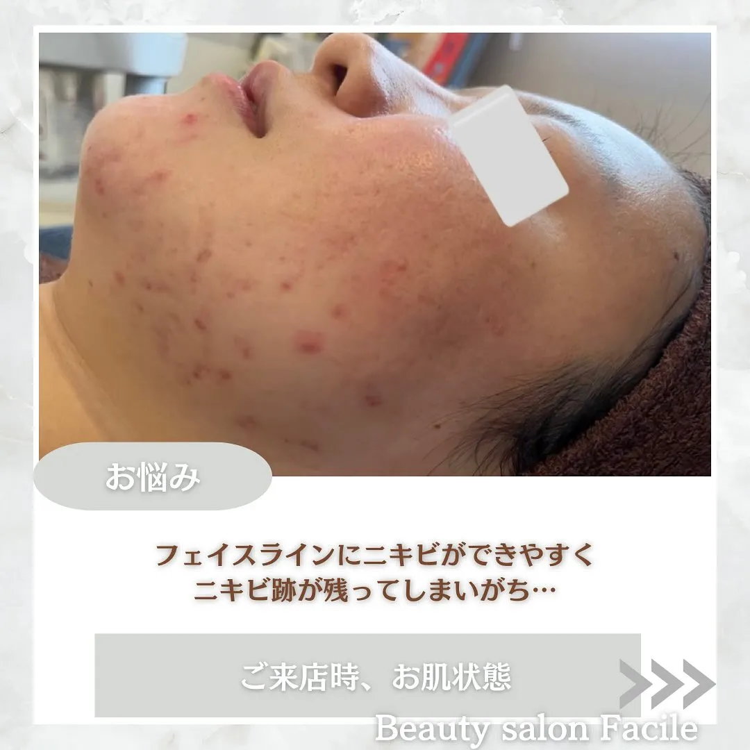 太田市にある頑固なニキビ専門店です✨️