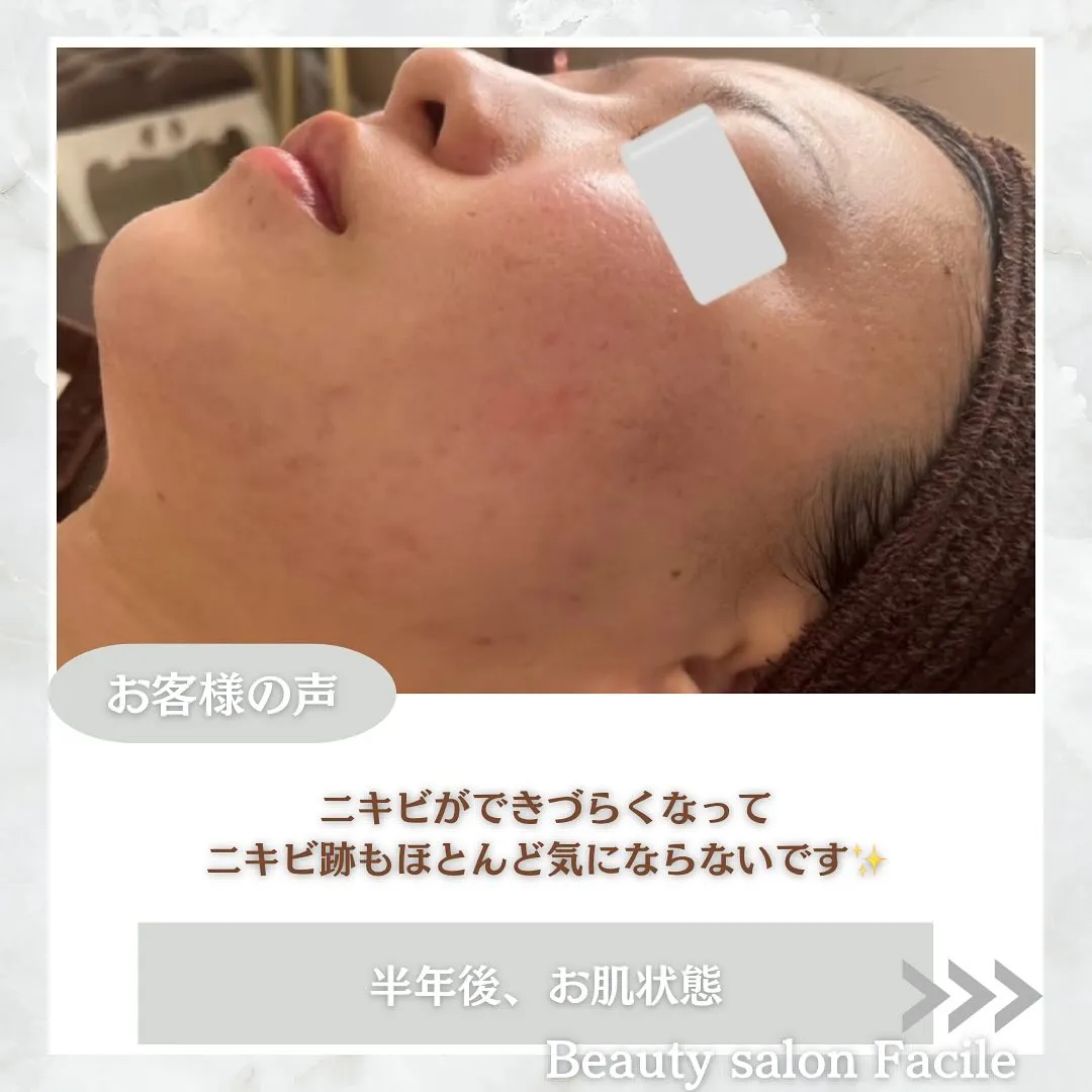 太田市にある頑固なニキビ専門店です✨️