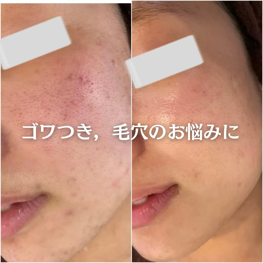 太田市にある頑固なニキビ専門店です✨️