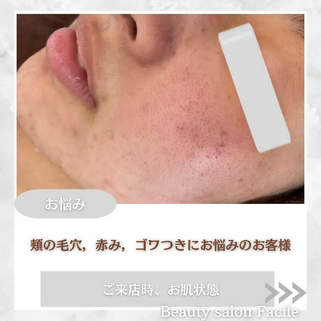 太田市にある頑固なニキビ専門店です✨️