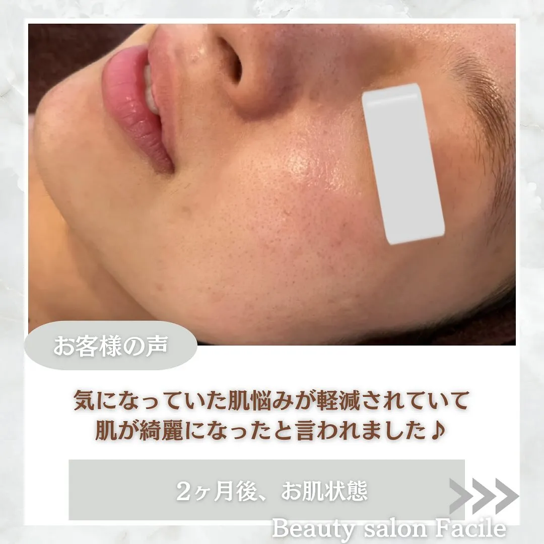 太田市にある頑固なニキビ専門店です✨️