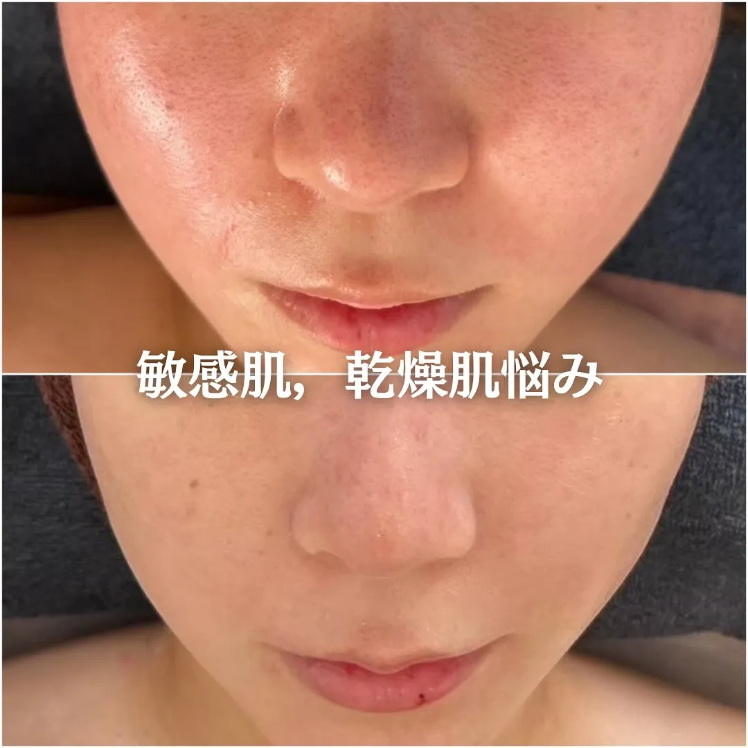 太田市にある頑固なニキビ専門店です✨️