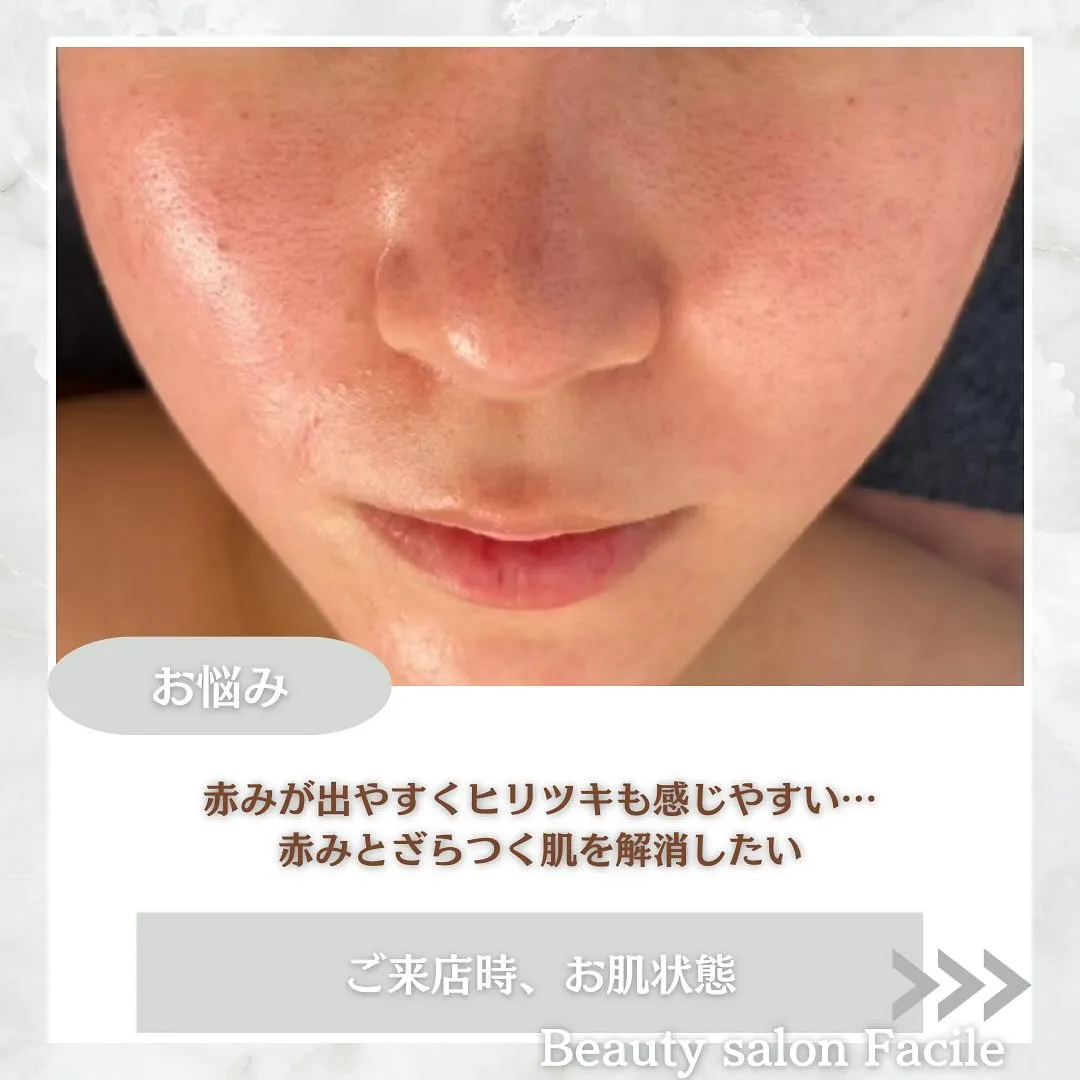 太田市にある頑固なニキビ専門店です✨️