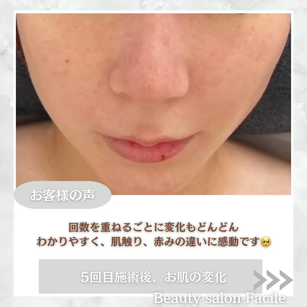 太田市にある頑固なニキビ専門店です✨️