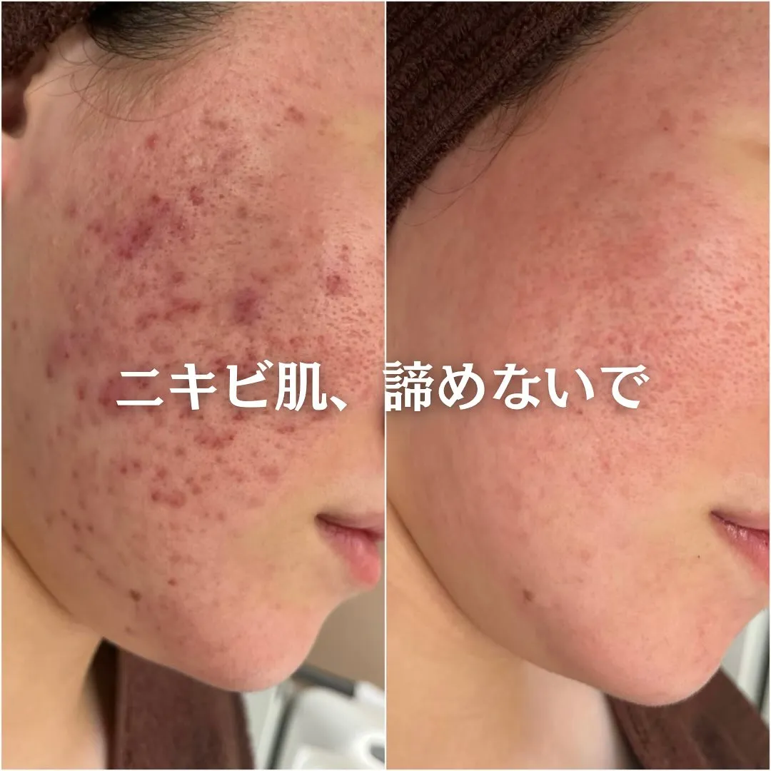太田市にある頑固なニキビ専門店です✨️