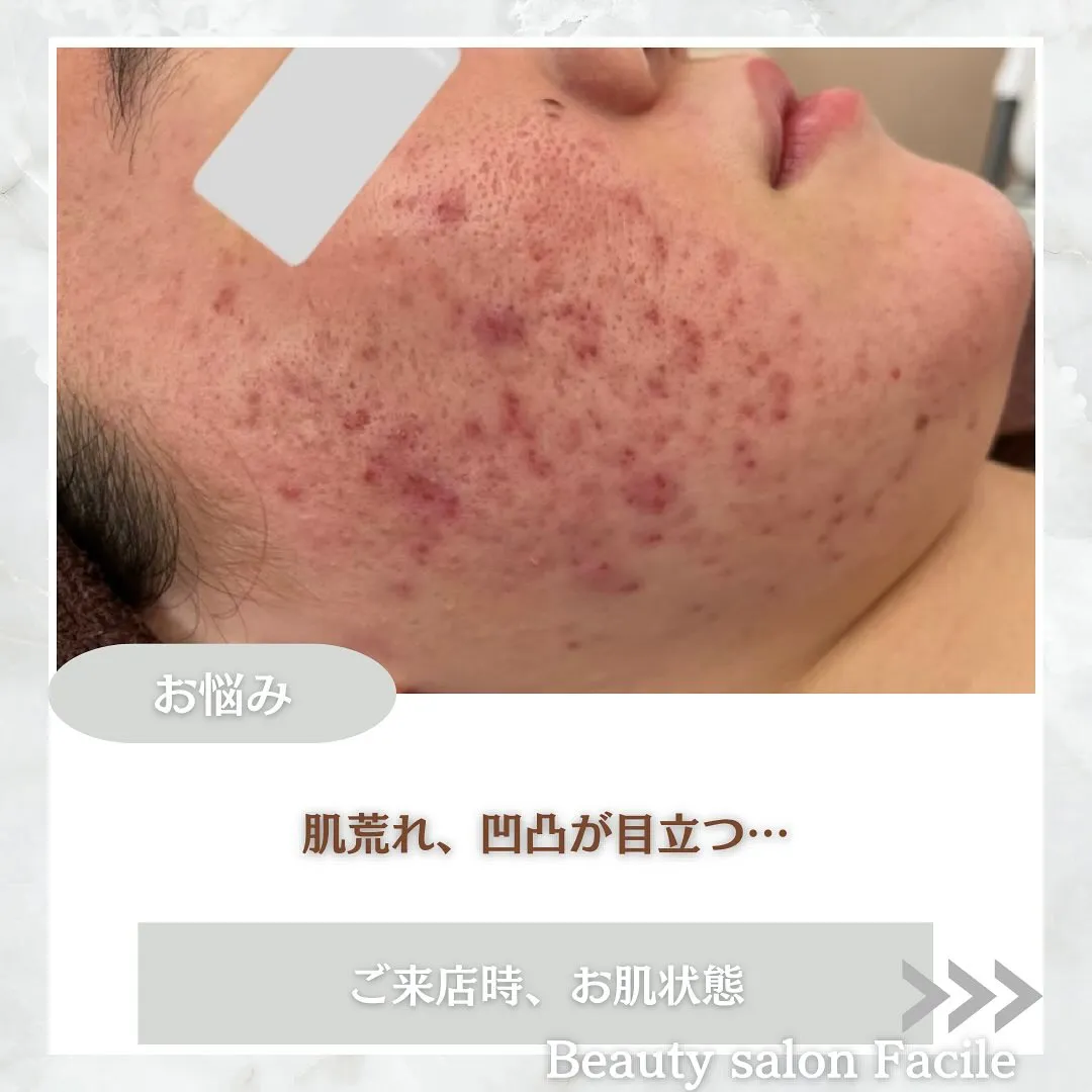 太田市にある頑固なニキビ専門店です✨️