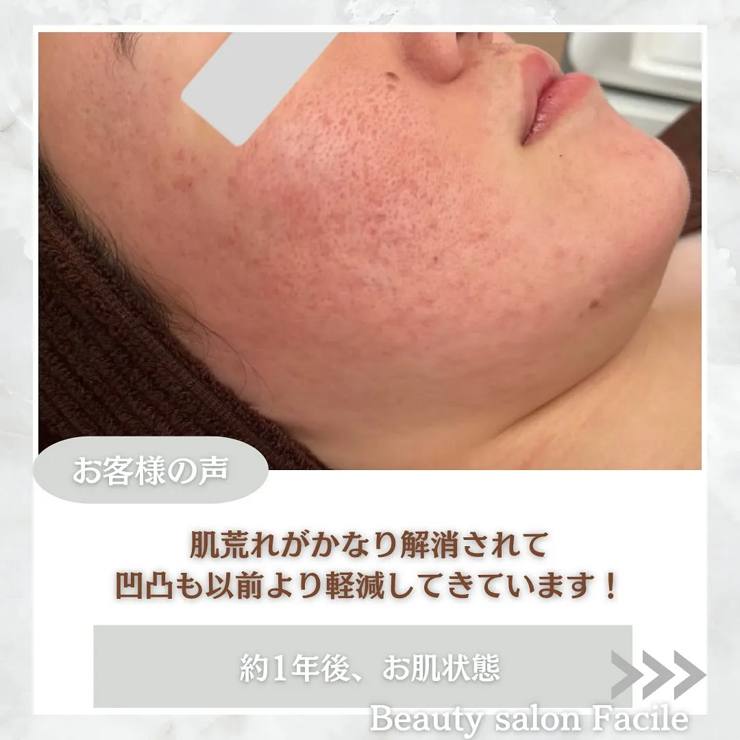 太田市にある頑固なニキビ専門店です✨️