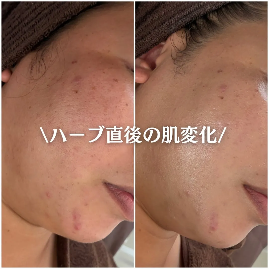 太田市にある頑固なニキビ専門店です✨️