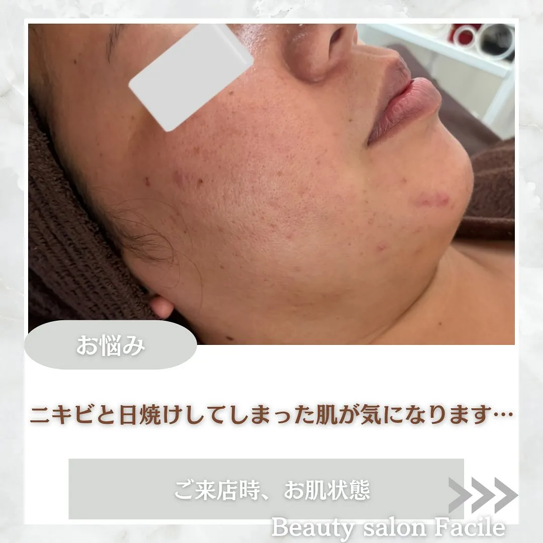 太田市にある頑固なニキビ専門店です✨️