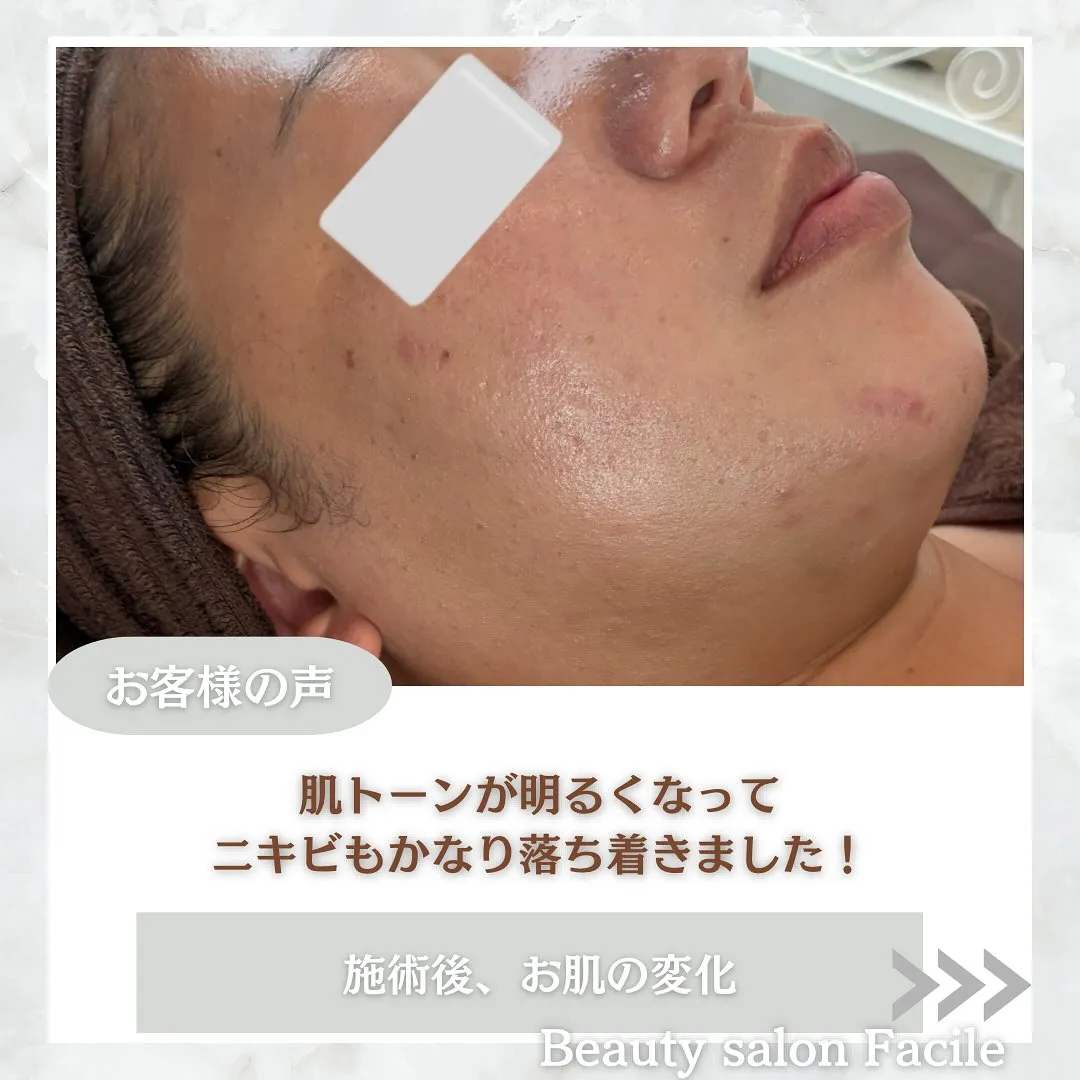 太田市にある頑固なニキビ専門店です✨️