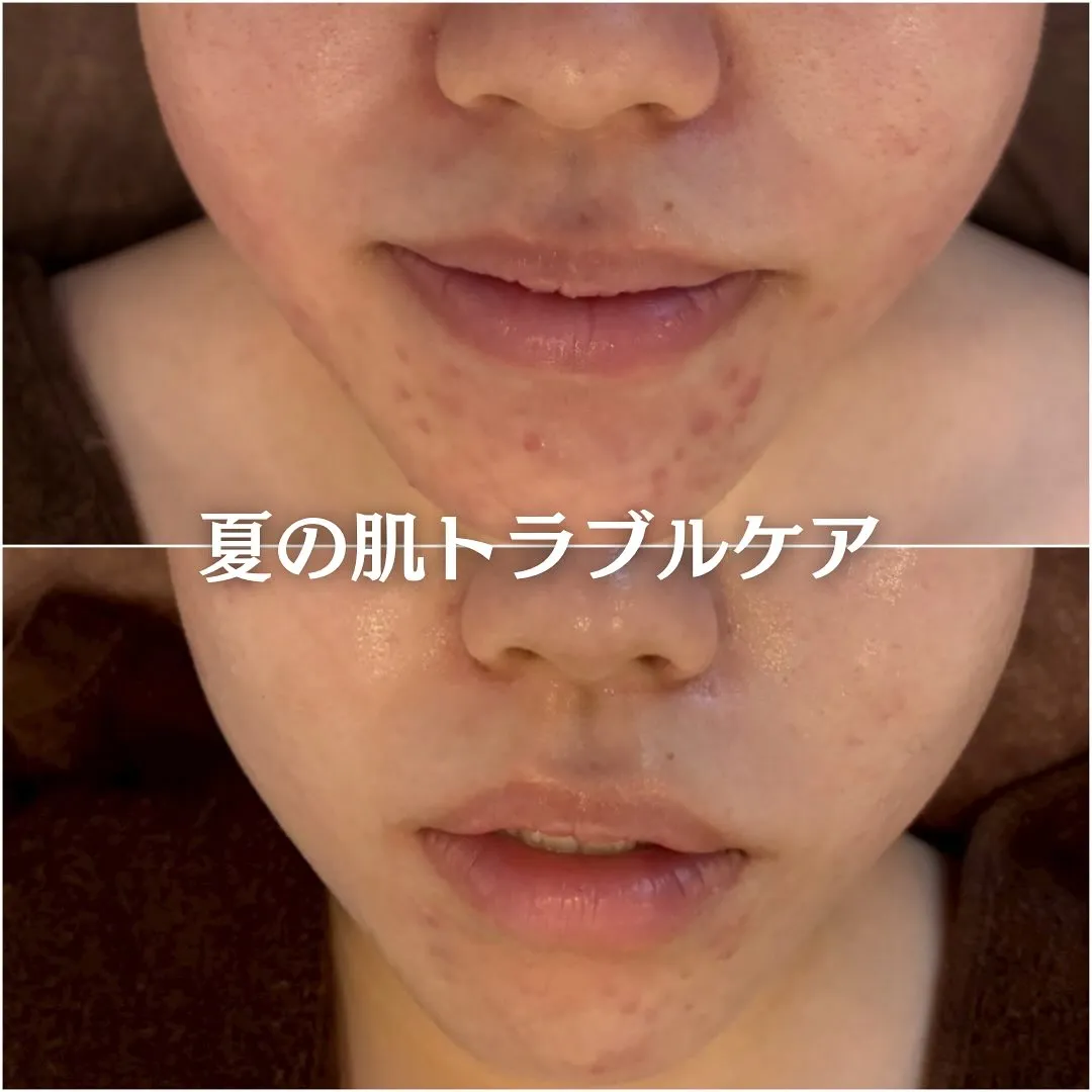 太田市にある頑固なニキビ専門店です✨️