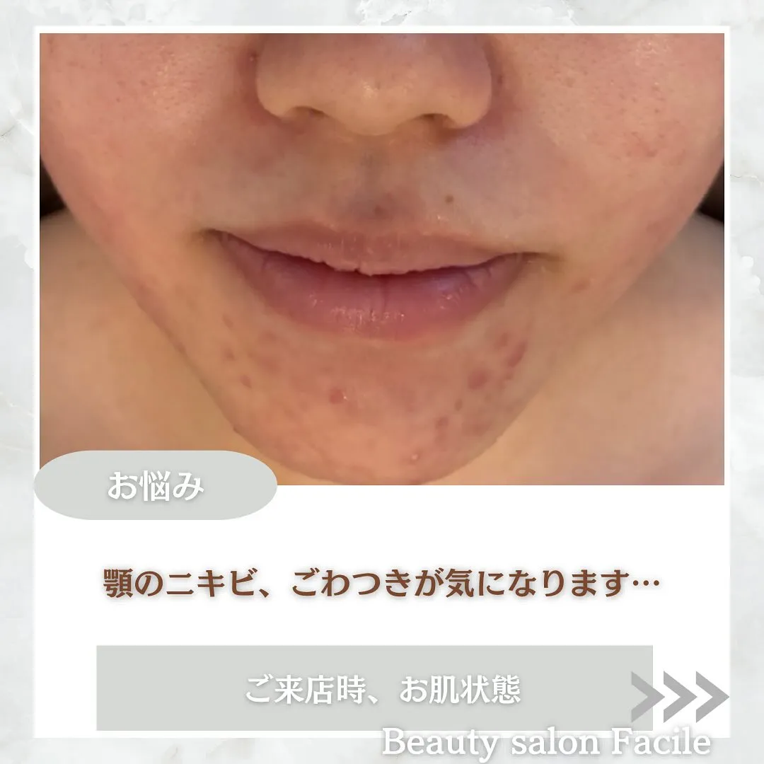 太田市にある頑固なニキビ専門店です✨️