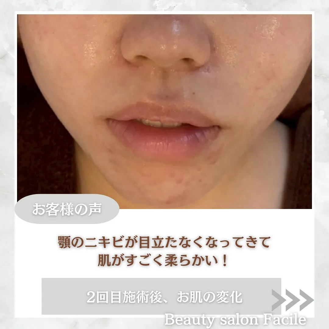 太田市にある頑固なニキビ専門店です✨️