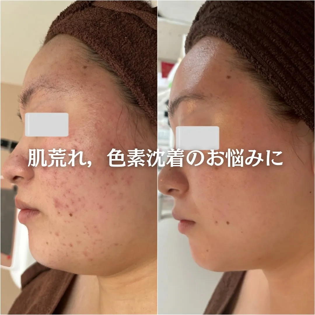 太田市にある頑固なニキビ専門店です✨️