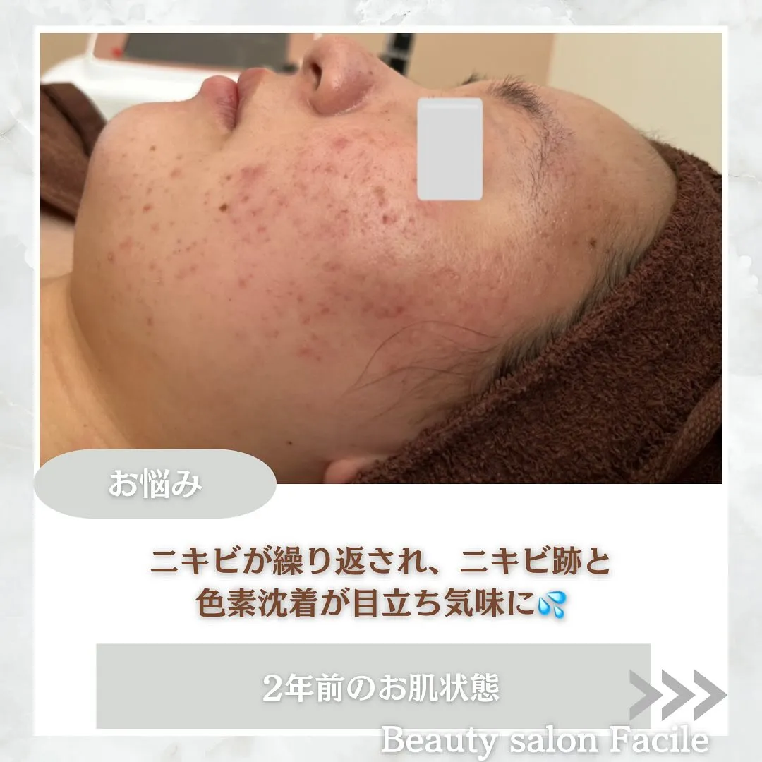 太田市にある頑固なニキビ専門店です✨️