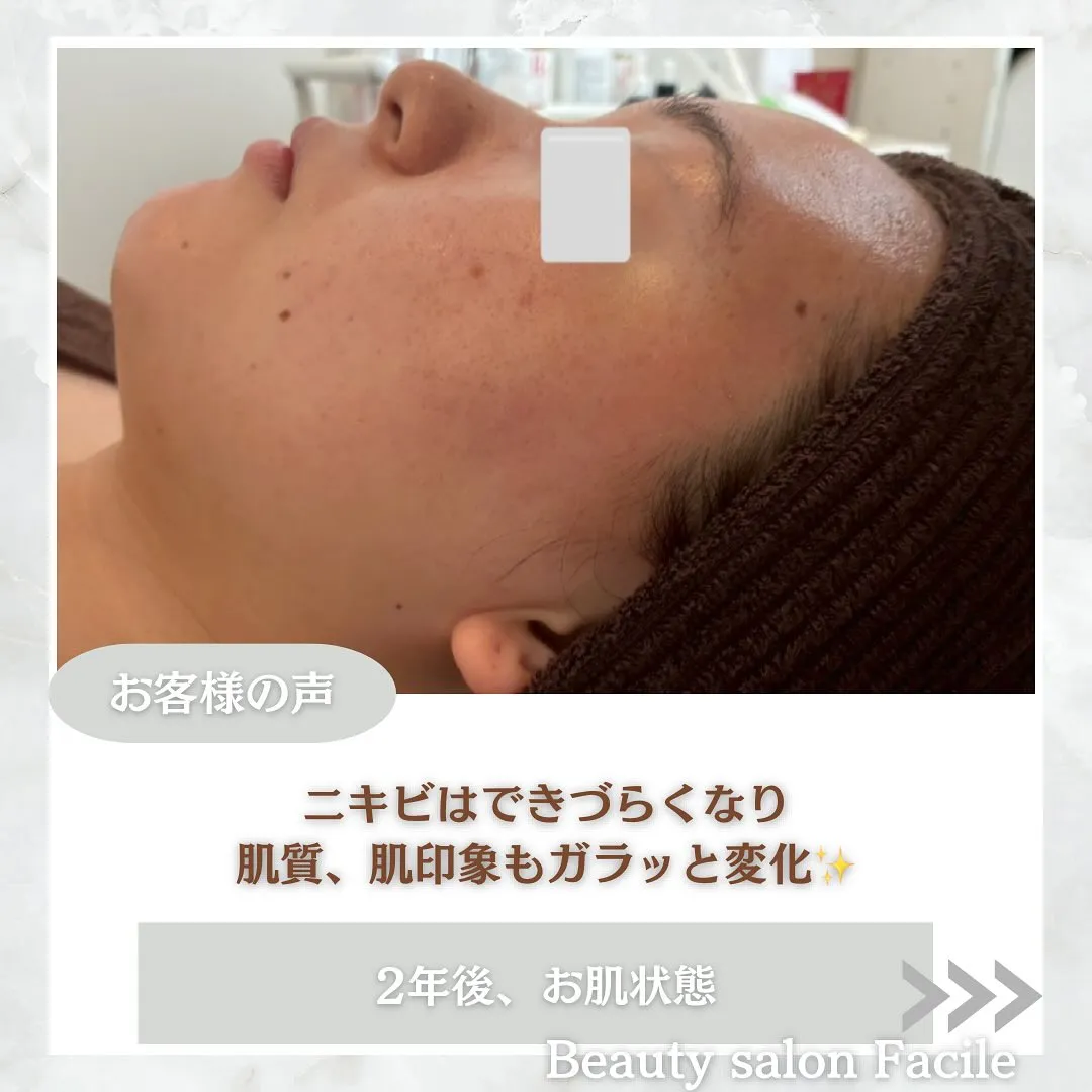 太田市にある頑固なニキビ専門店です✨️