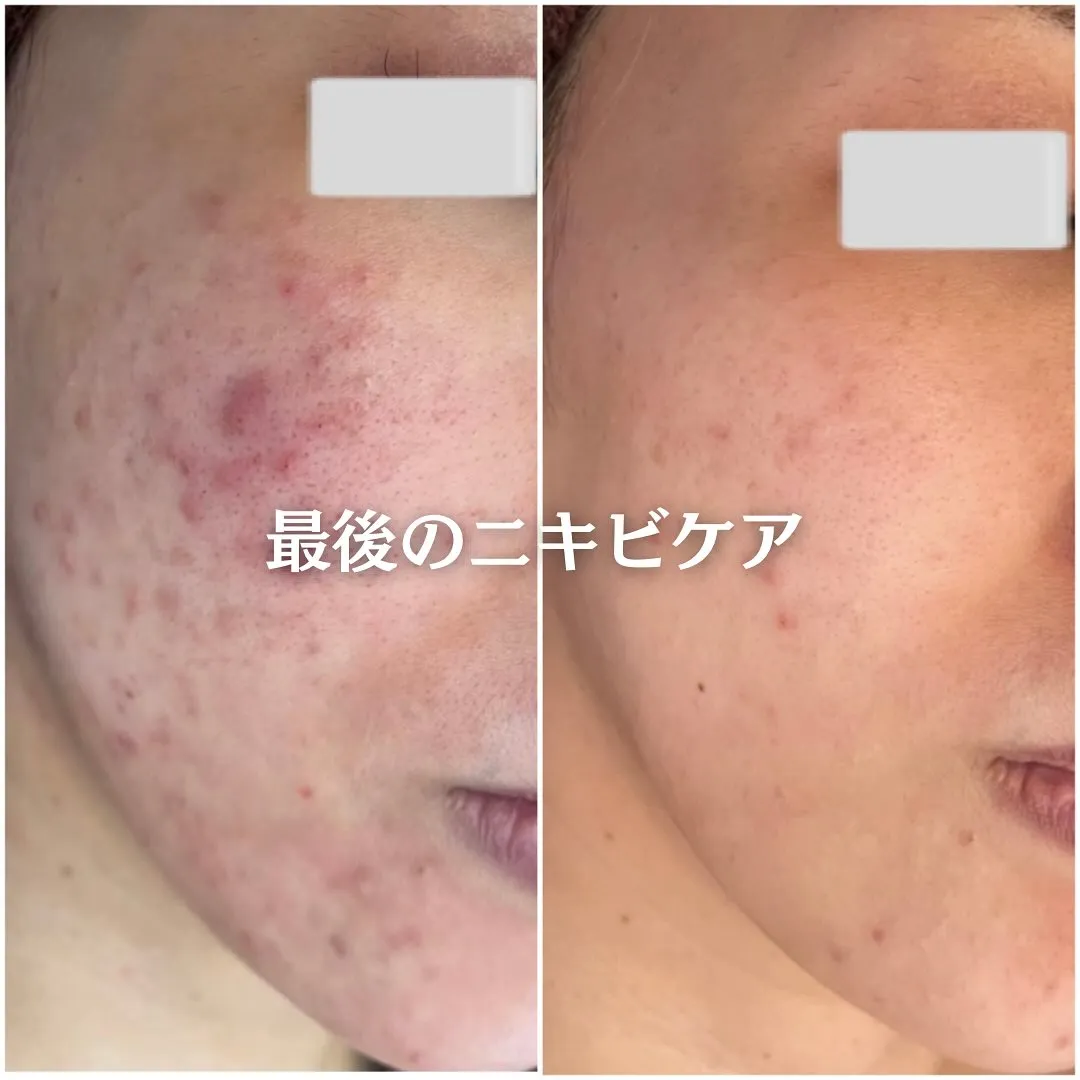 太田市にある頑固なニキビ専門店です✨️