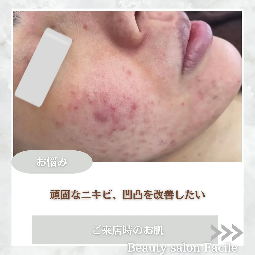 太田市にある頑固なニキビ専門店です✨️