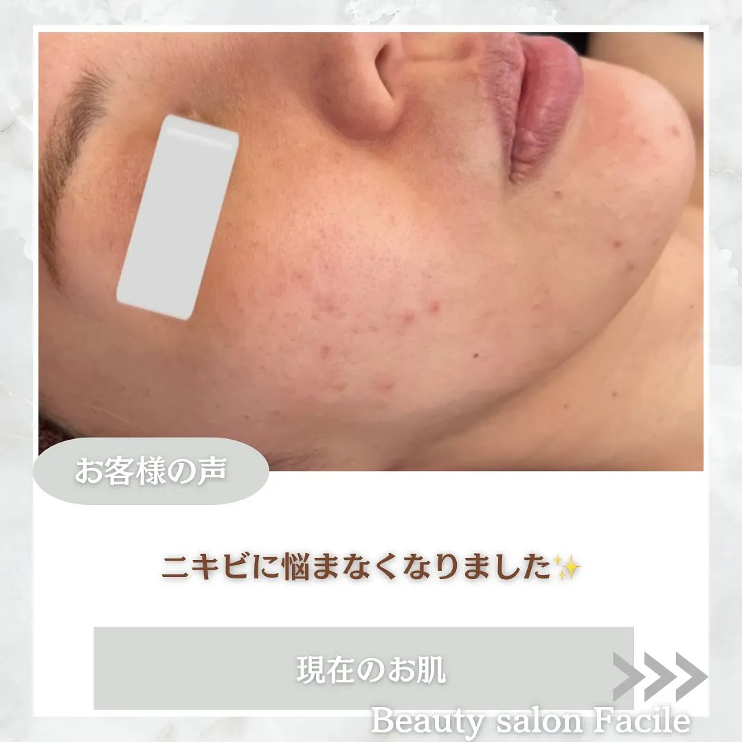 太田市にある頑固なニキビ専門店です✨️