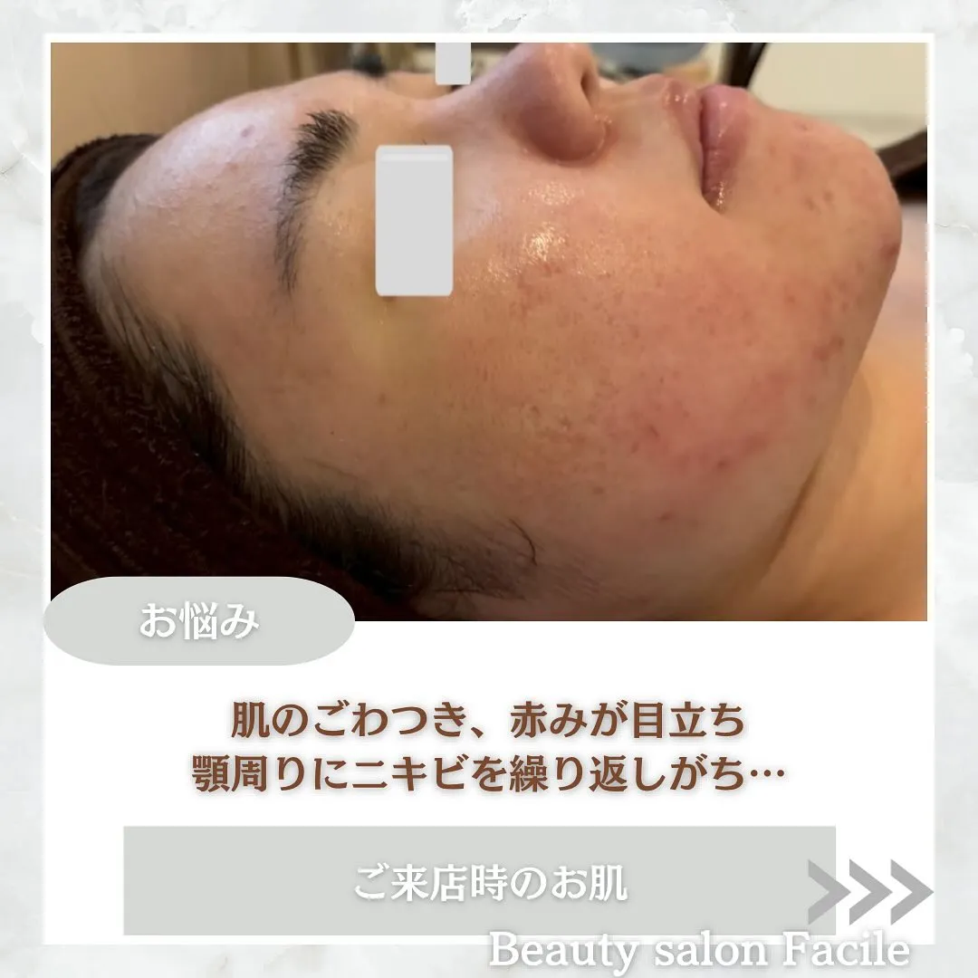 太田市にある頑固なニキビ専門店です✨️