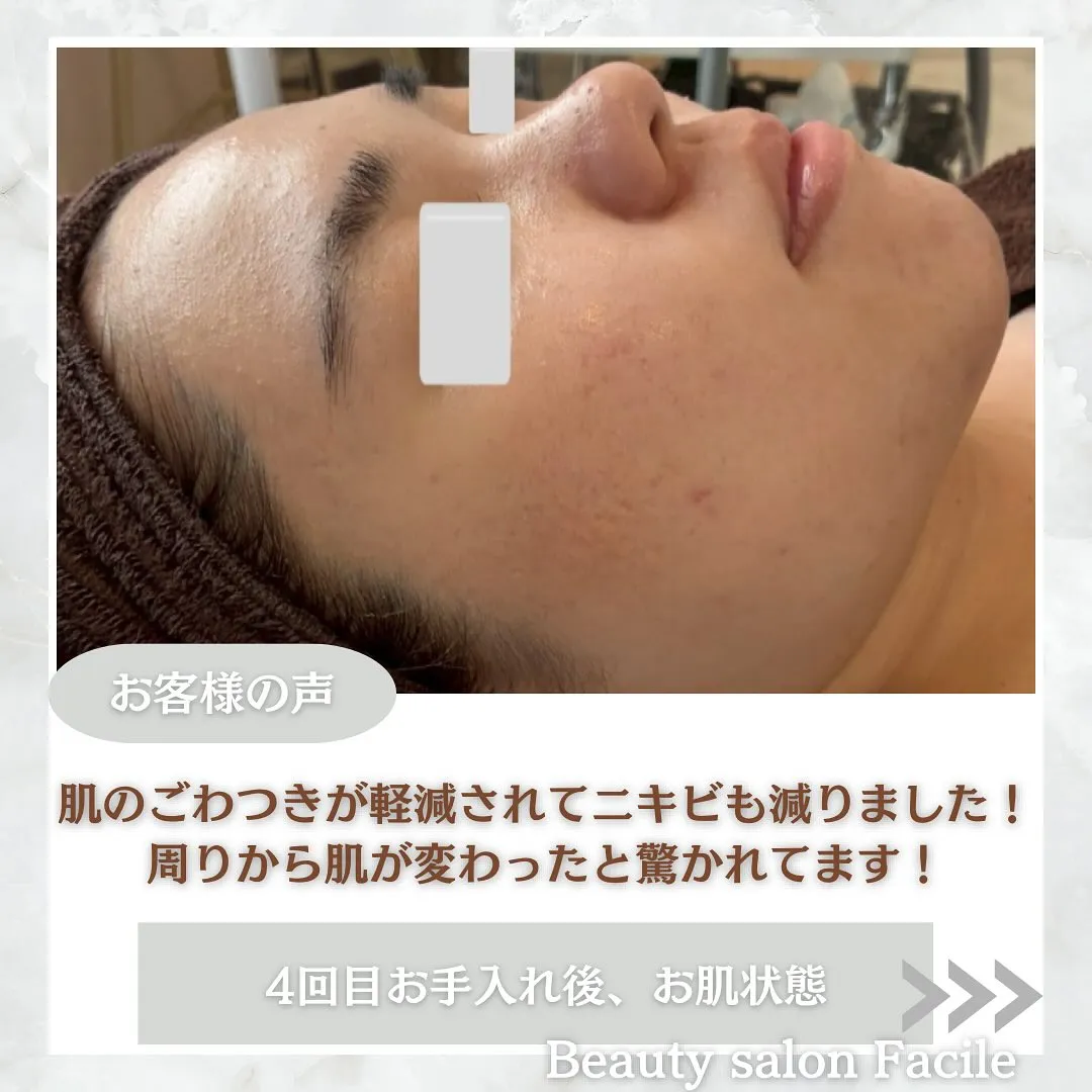 太田市にある頑固なニキビ専門店です✨️