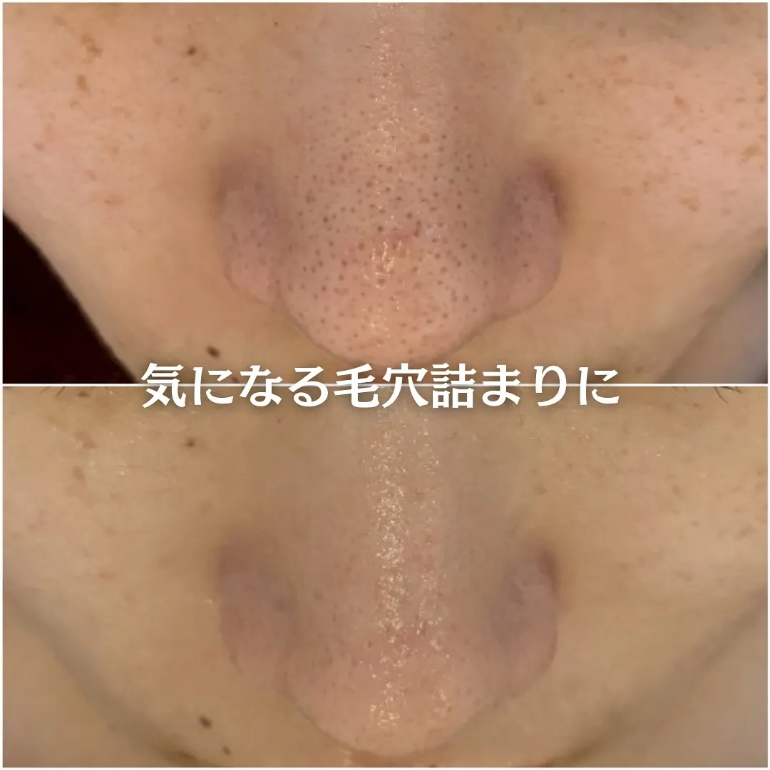 太田市にある頑固なニキビ専門店です✨️