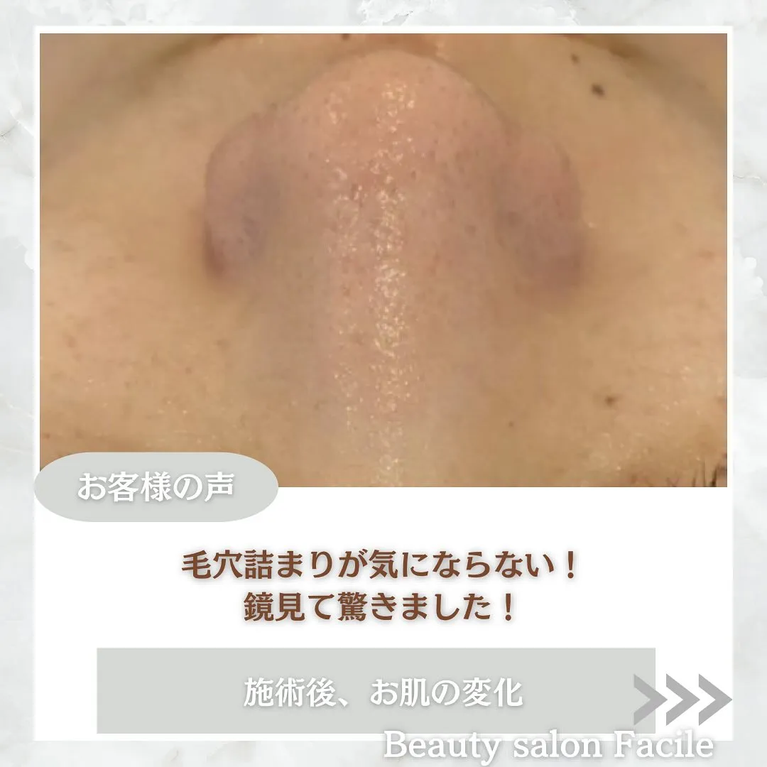 太田市にある頑固なニキビ専門店です✨️