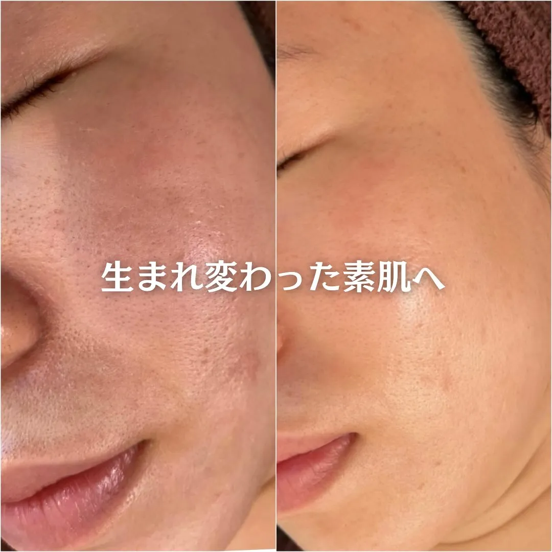 太田市にある頑固なニキビ専門店です✨️