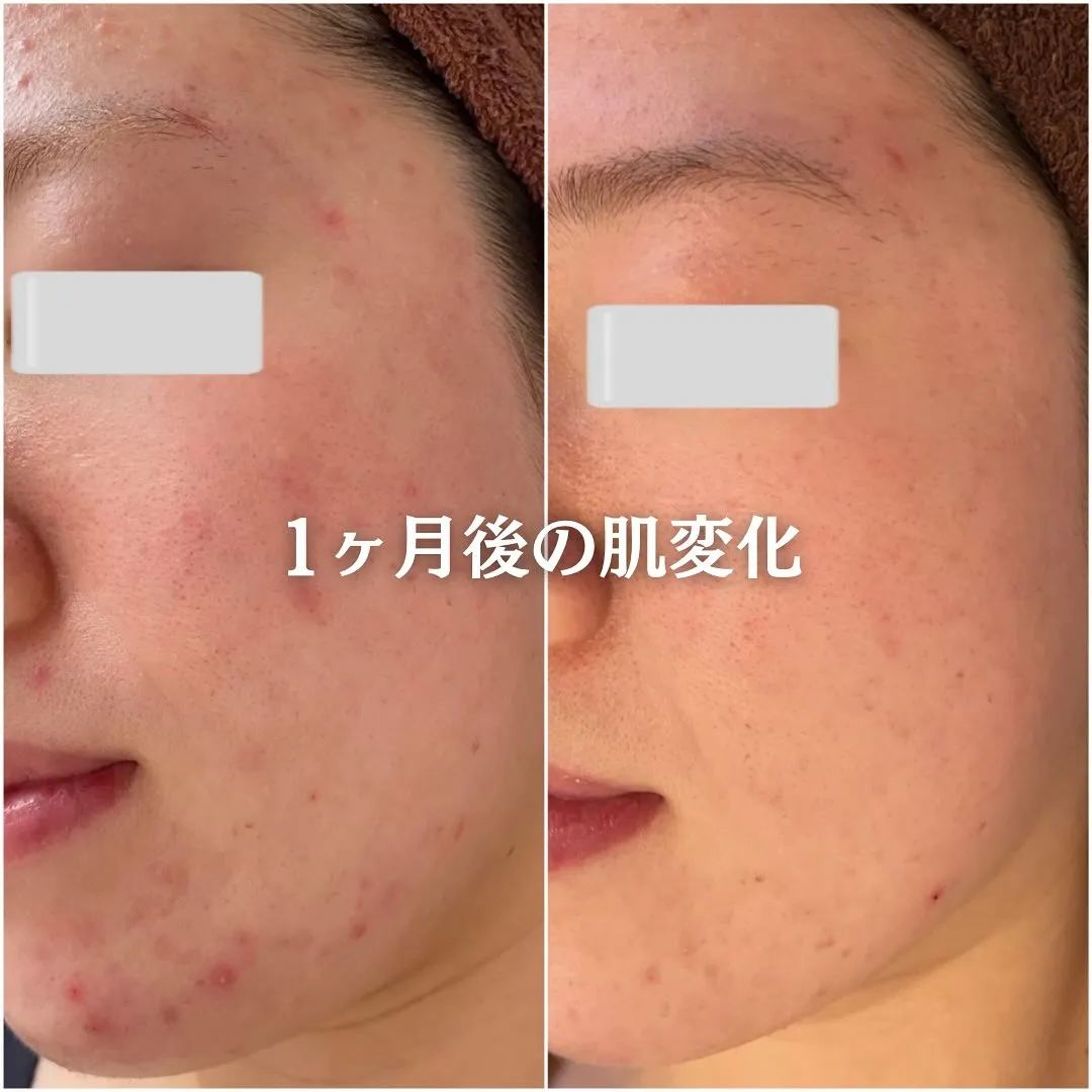 太田市にある頑固なニキビ専門店です✨️