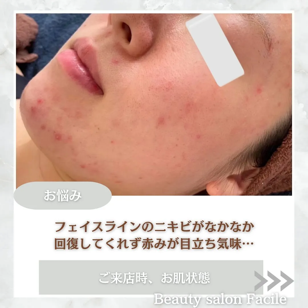 太田市にある頑固なニキビ専門店です✨️