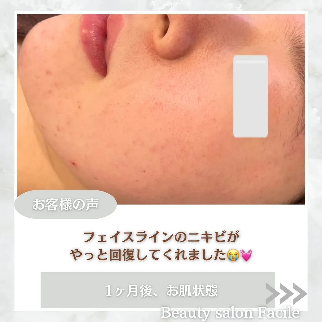 太田市にある頑固なニキビ専門店です✨️