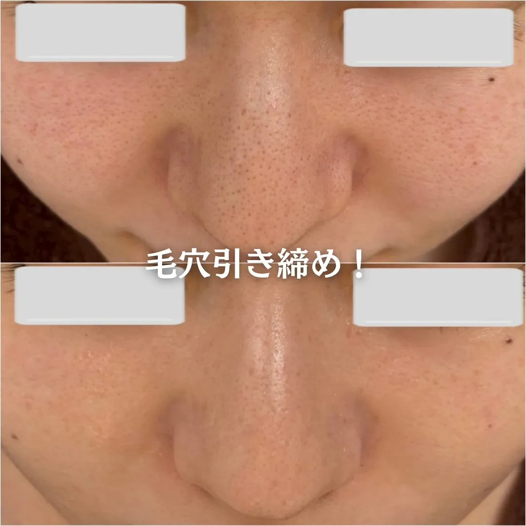 太田市にある頑固なニキビ専門店です✨️