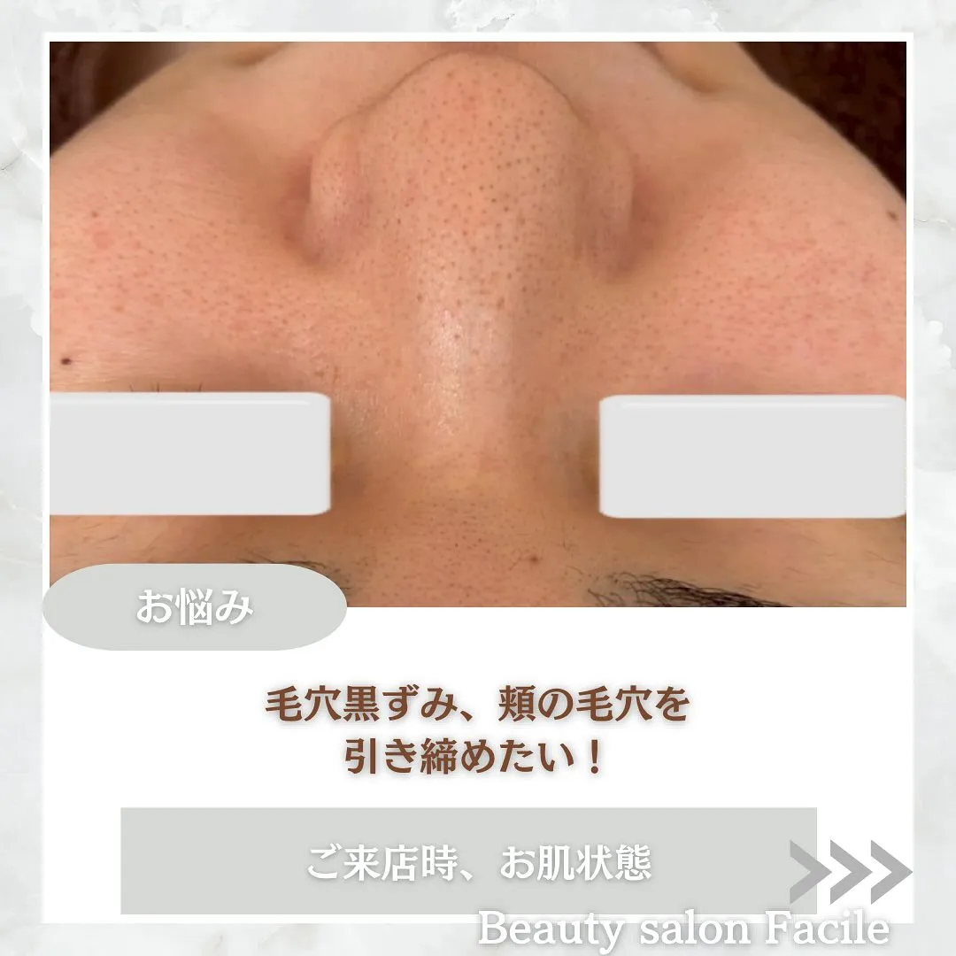 太田市にある頑固なニキビ専門店です✨️