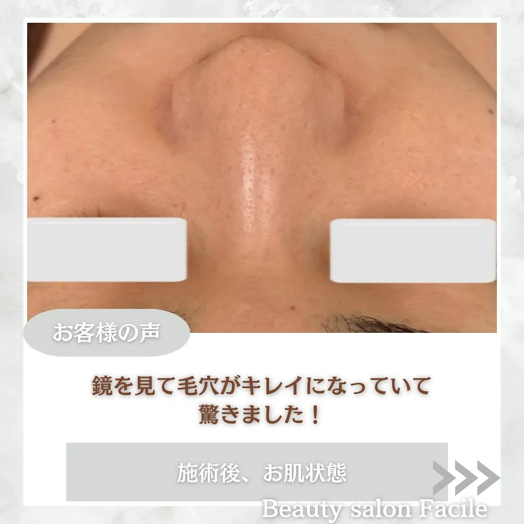 太田市にある頑固なニキビ専門店です✨️