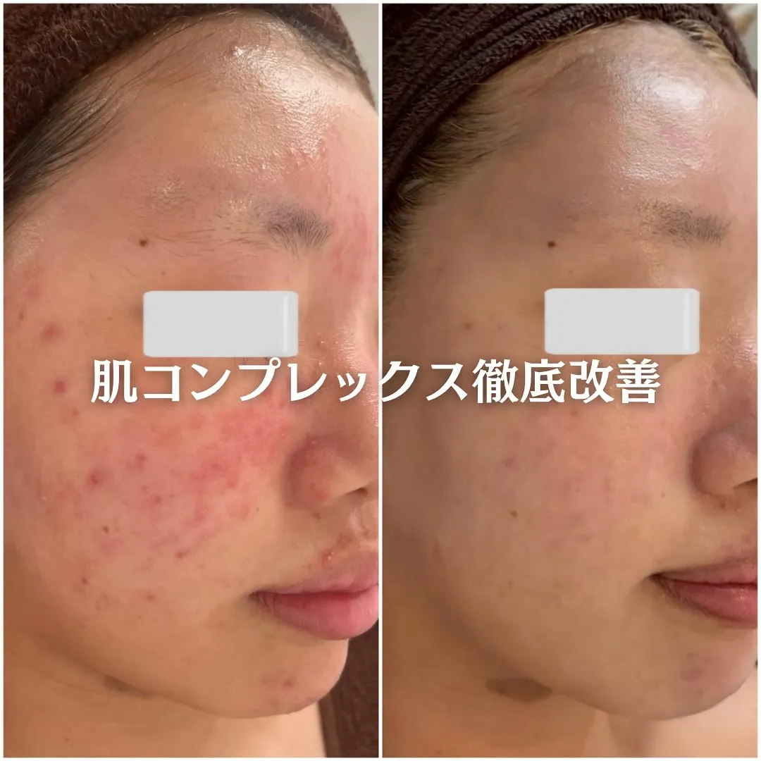 太田市にある頑固なニキビ専門店です✨️