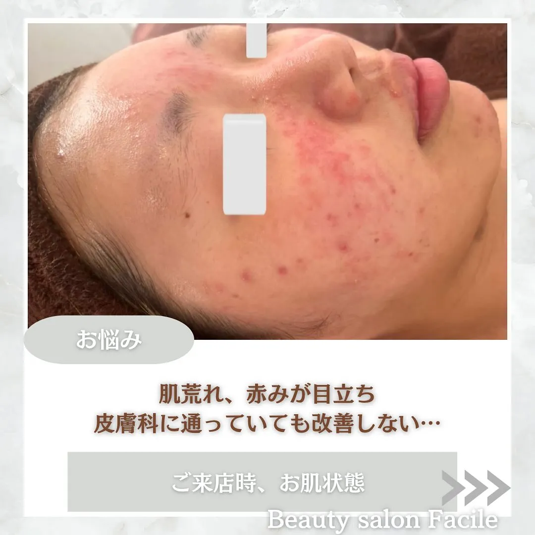 太田市にある頑固なニキビ専門店です✨️