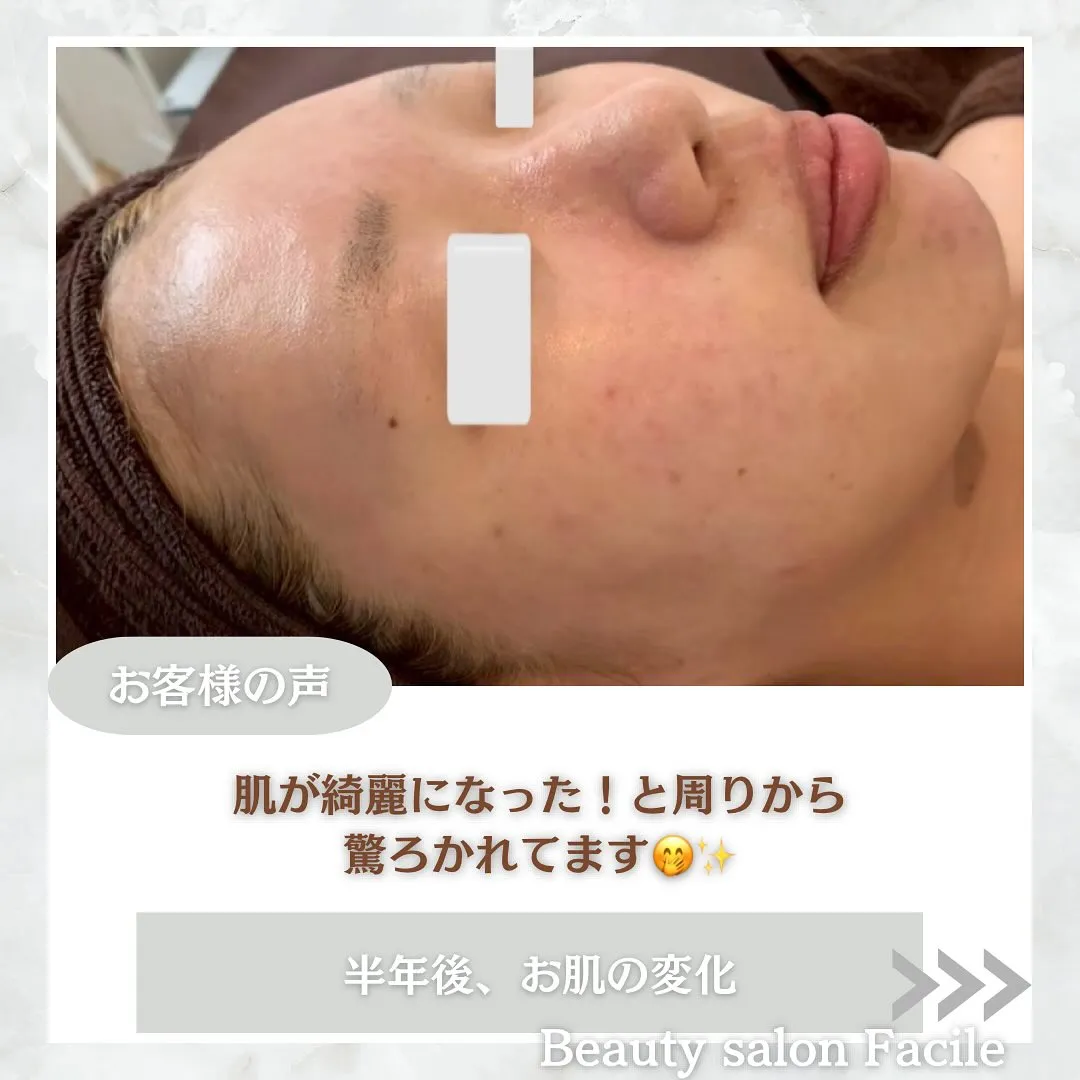 太田市にある頑固なニキビ専門店です✨️