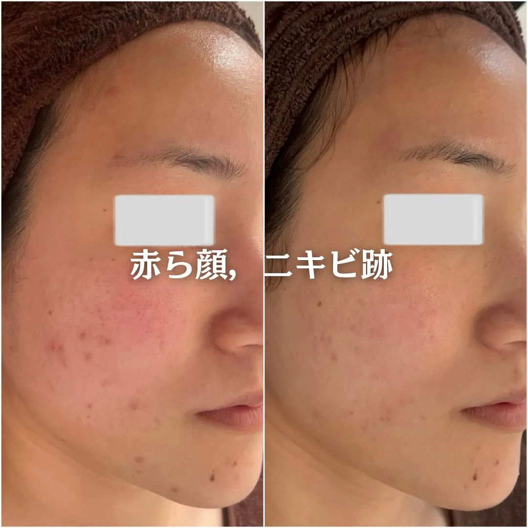 太田市にある頑固なニキビ専門店です✨️