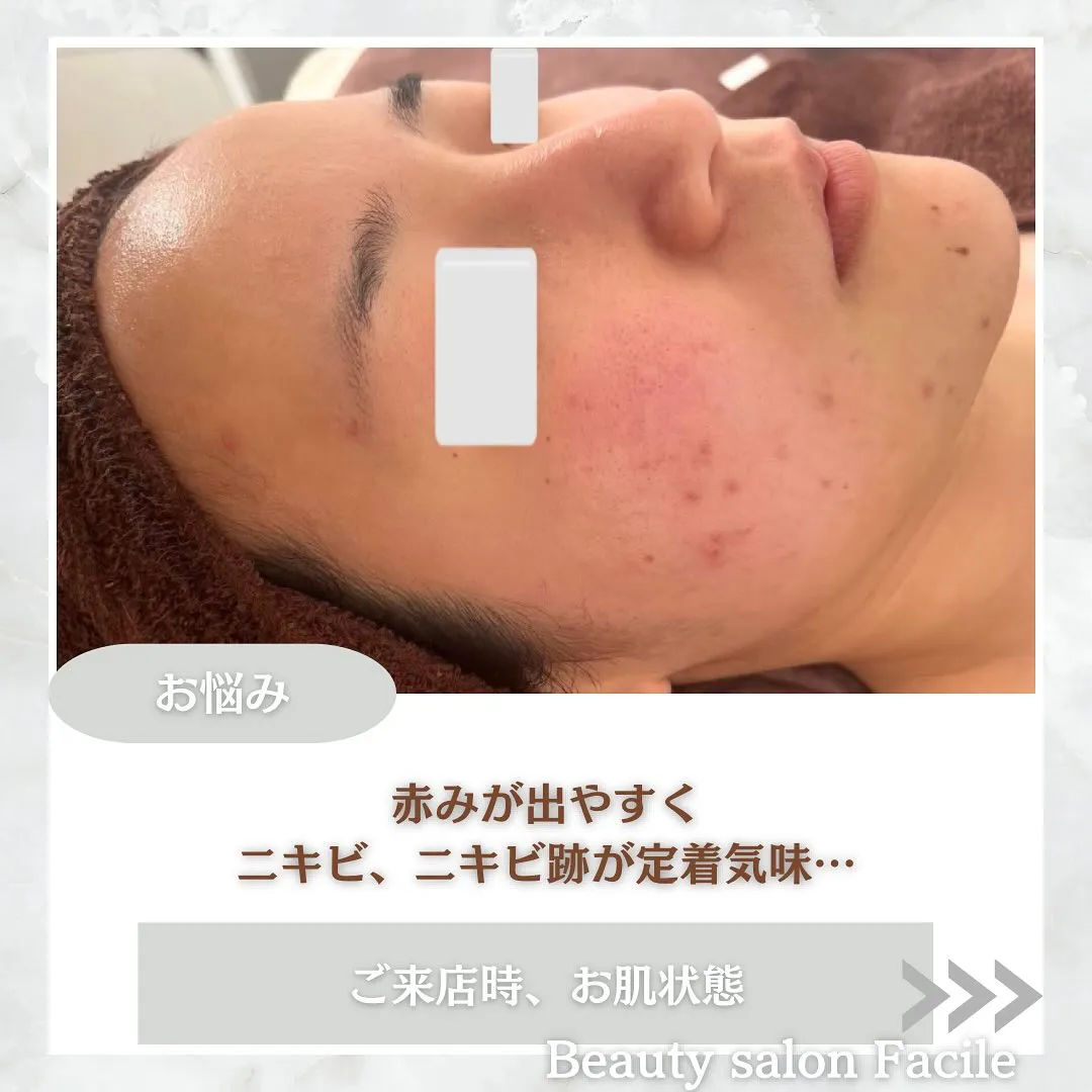 太田市にある頑固なニキビ専門店です✨️