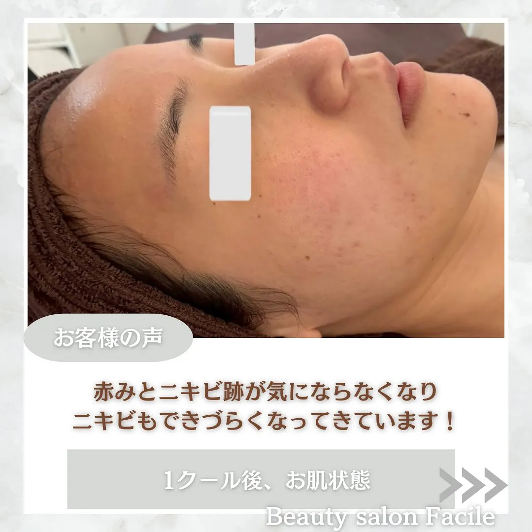 太田市にある頑固なニキビ専門店です✨️