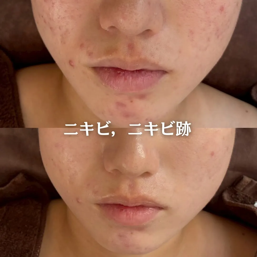 太田市にある頑固なニキビ専門店です✨️