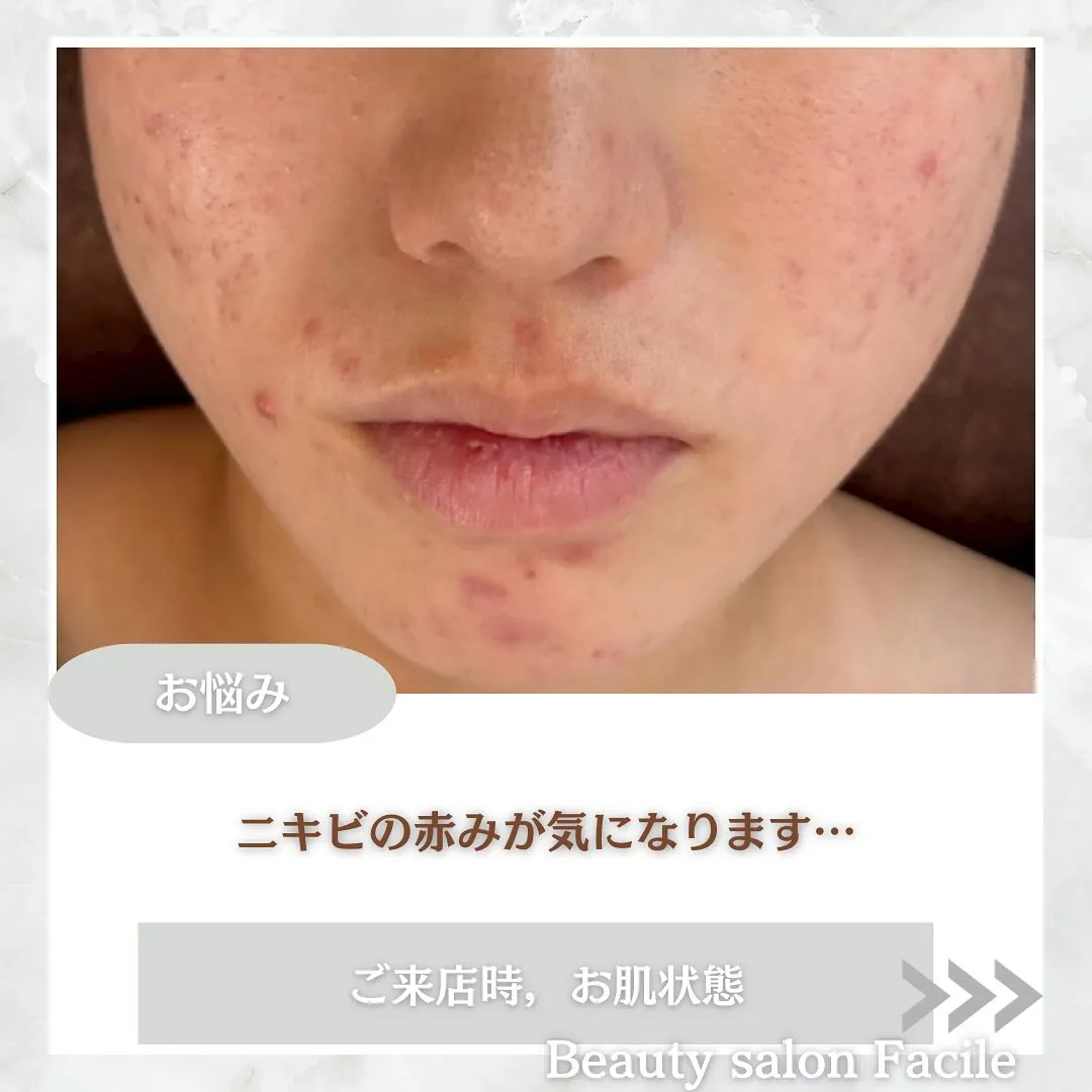 太田市にある頑固なニキビ専門店です✨️