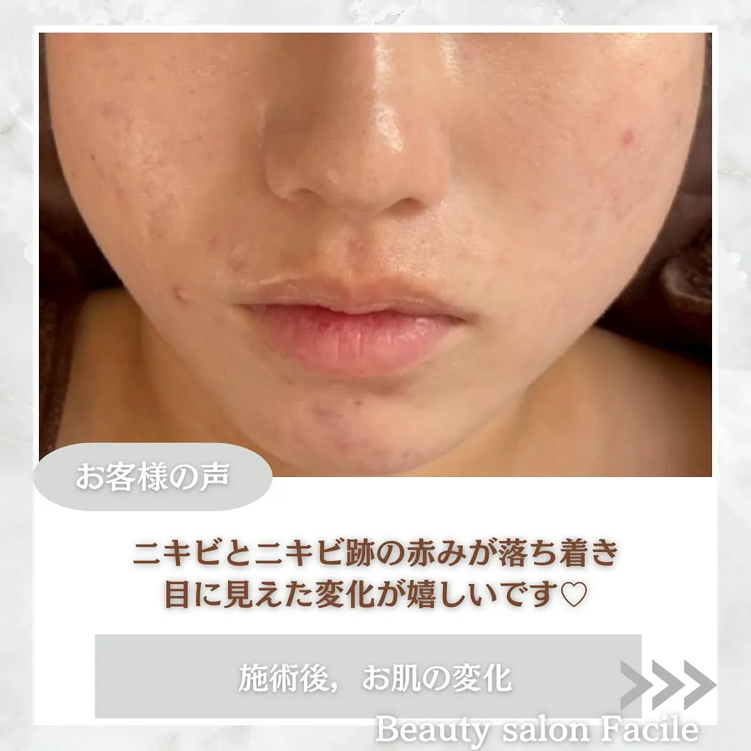 太田市にある頑固なニキビ専門店です✨️