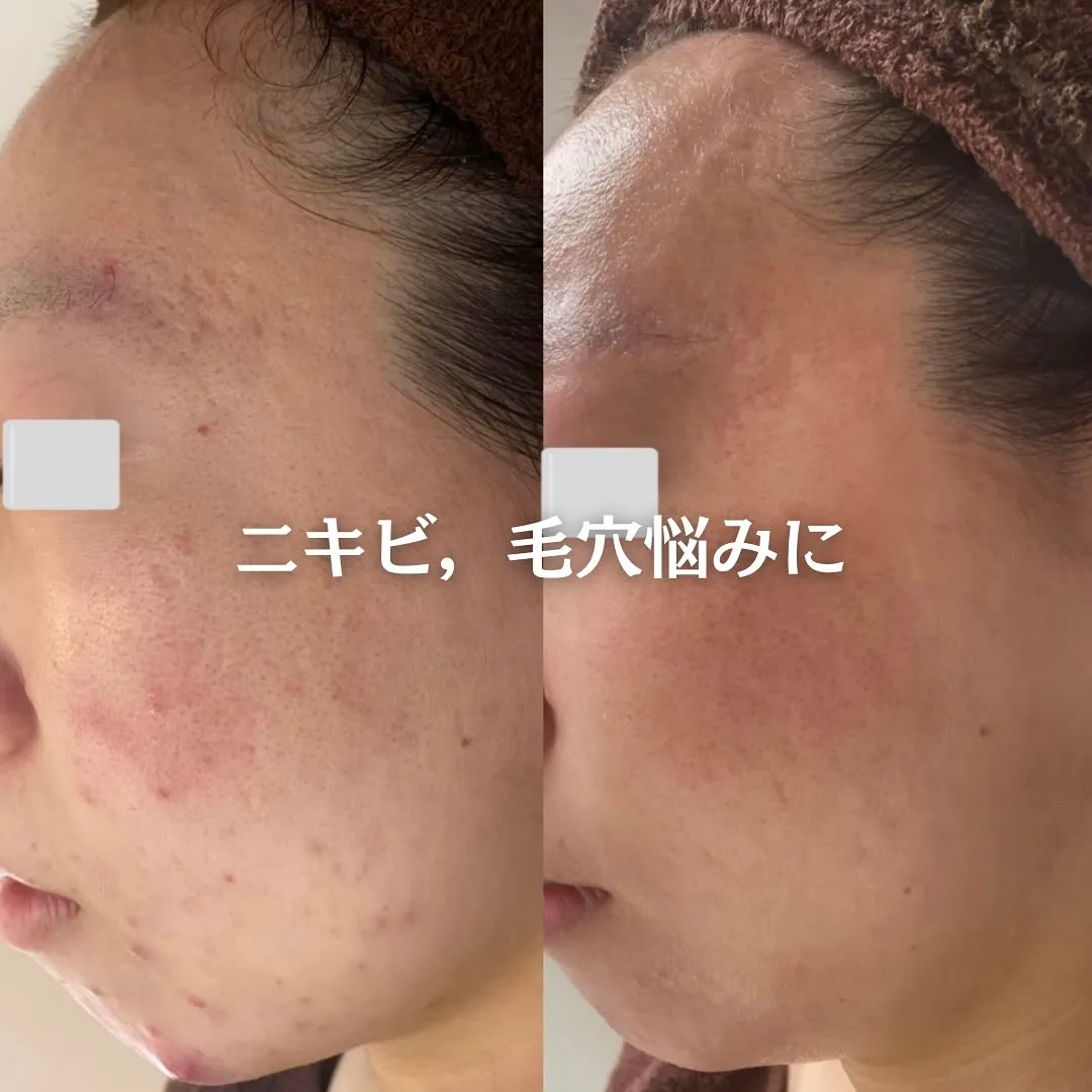 太田市にある頑固なニキビ専門店です✨️