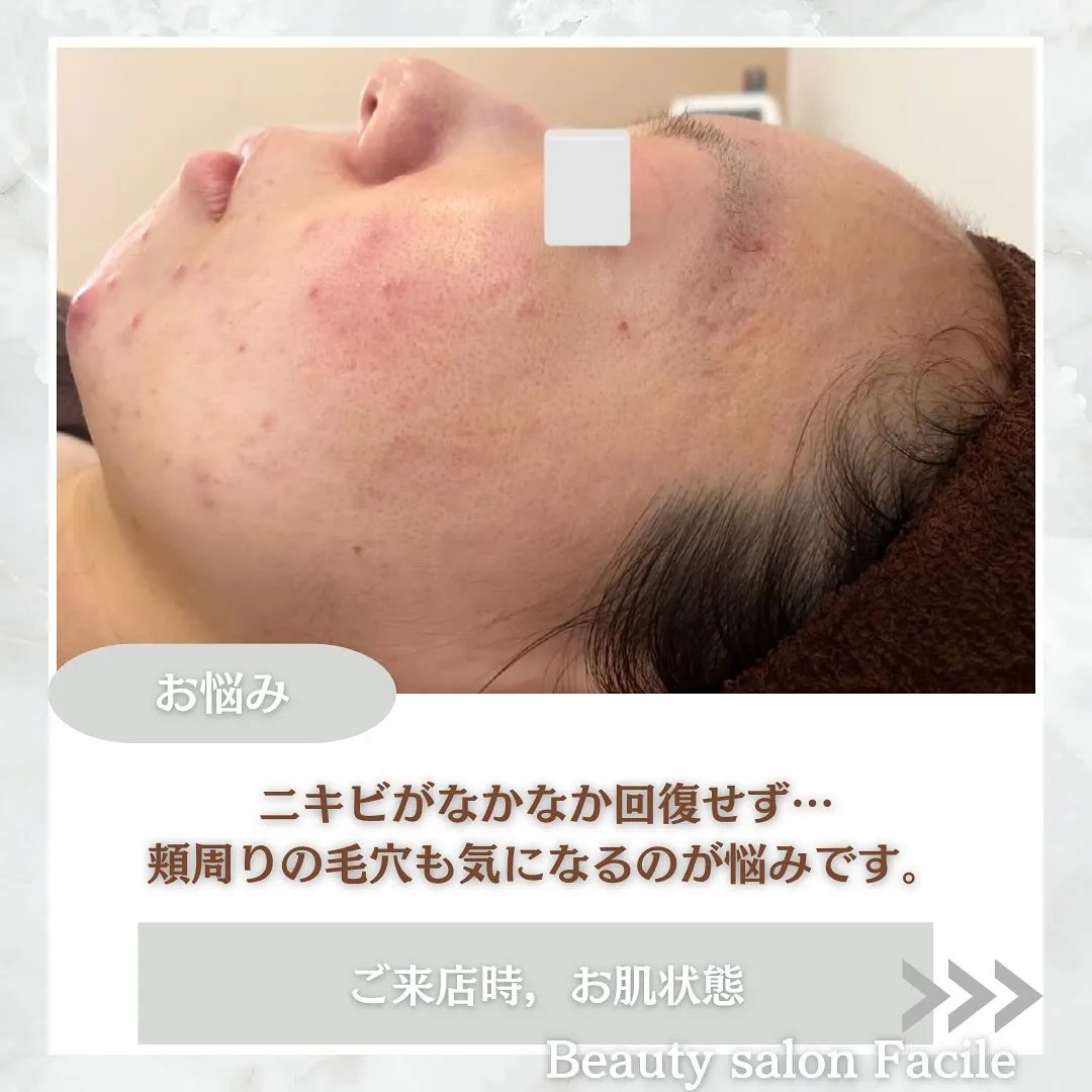 太田市にある頑固なニキビ専門店です✨️