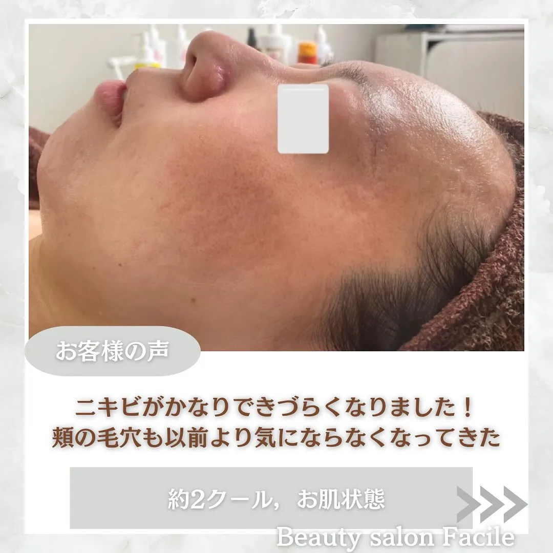 太田市にある頑固なニキビ専門店です✨️