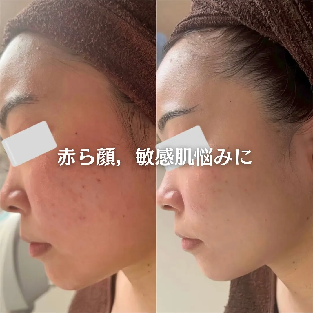 太田市にある頑固なニキビ専門店です✨️