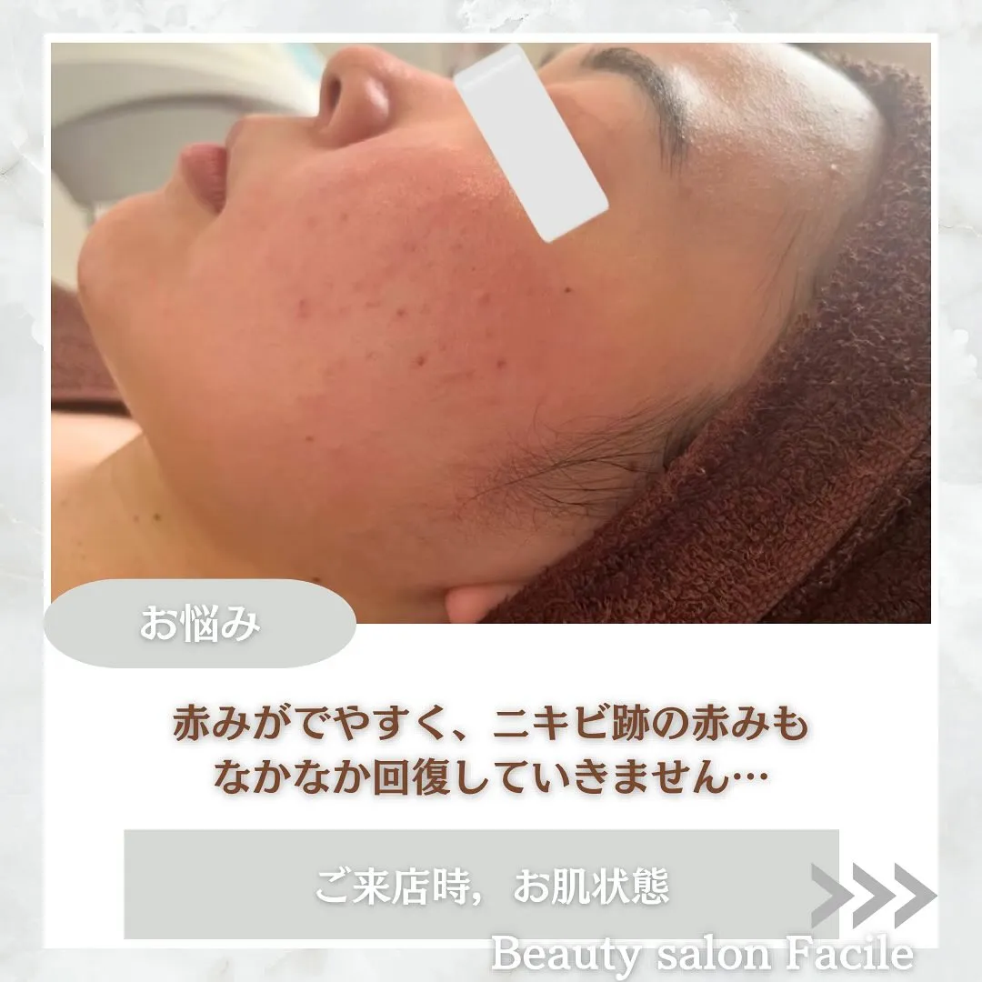 太田市にある頑固なニキビ専門店です✨️