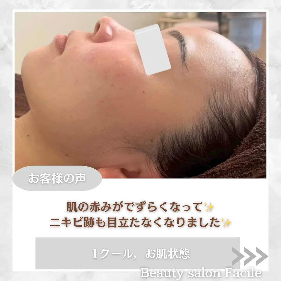 太田市にある頑固なニキビ専門店です✨️