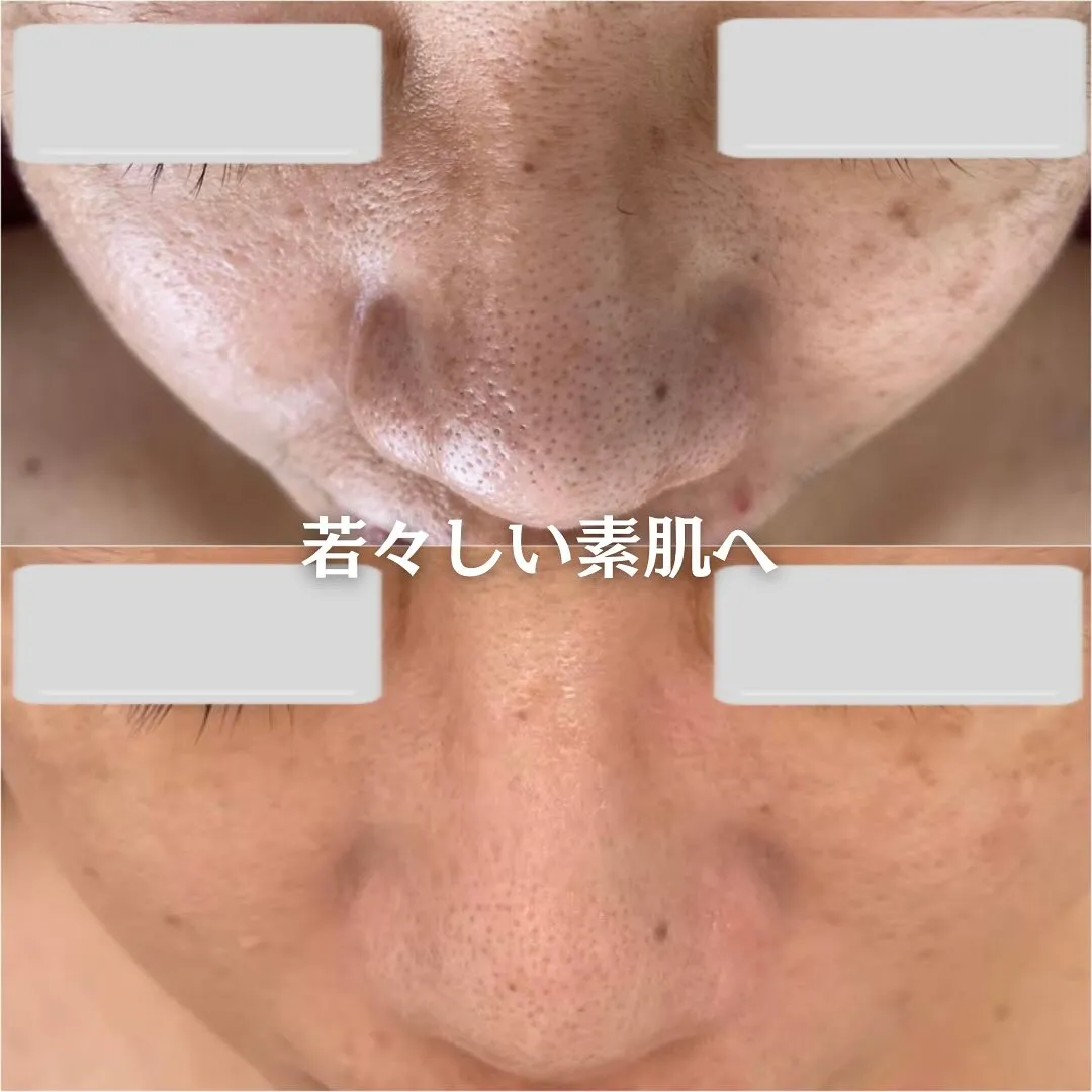 太田市にある頑固なニキビ専門店です✨️